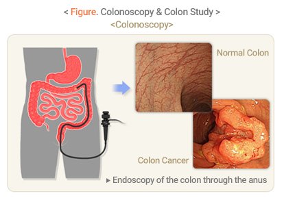 Colonoscopy & Colon Study