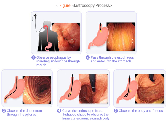 Figure. Gastroscopy Process