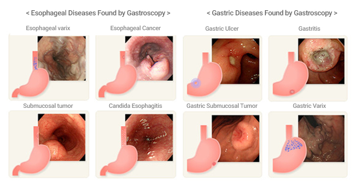 figure. Esophageal Diseases Found by Gastroscopy, Gastric Diseases Found by Gastroscopy 