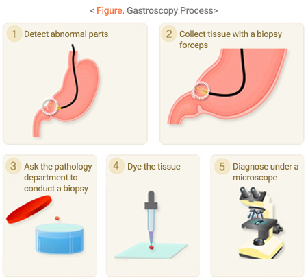 Figure. Gastroscopy Process