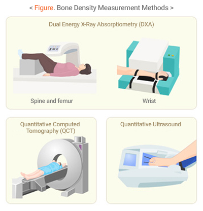 Figure. Bone Density Measurement Methods